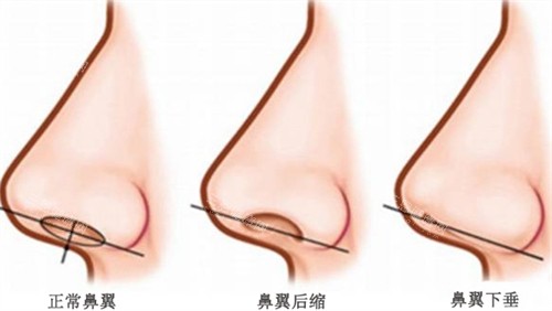 不同鼻翼对比