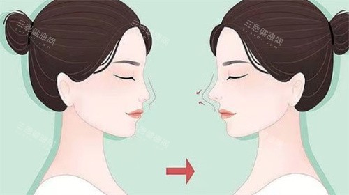 鼻修复对比 鼻修复对比