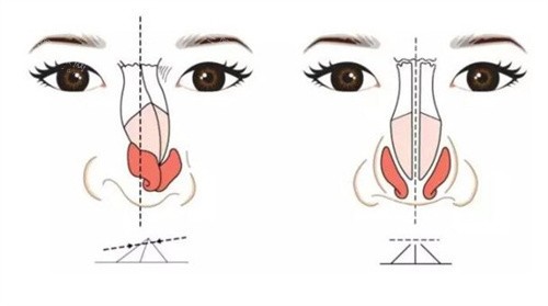 隆鼻修复 隆鼻修复