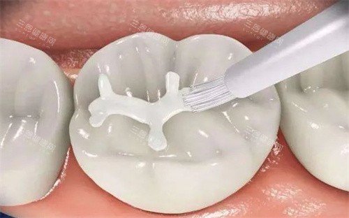 儿童窝沟封闭怎么做的