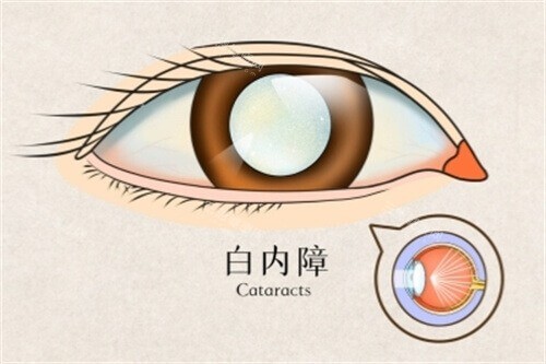 白内障卡通图