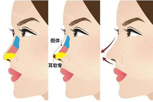 隆鼻卡通图