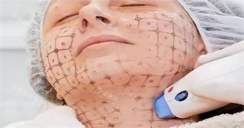热玛吉中下面部设计点位图