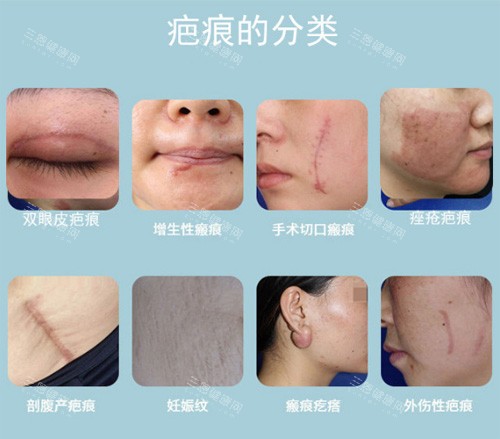 疤痕分类