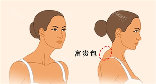 富贵包消除前后对比