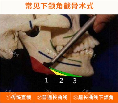 不同下颌角术式展示
