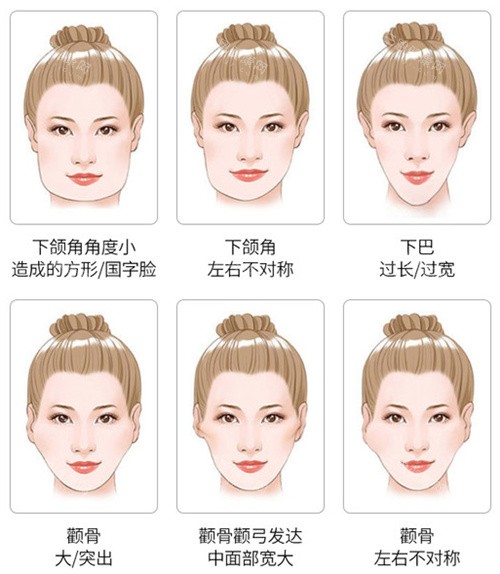 颧骨整形适应症