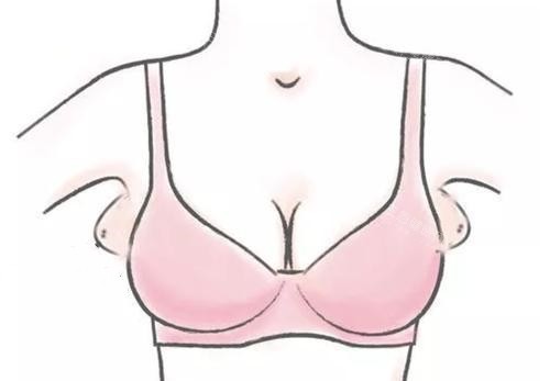 副乳位置卡通示意图