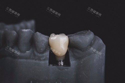 牙齿修复示意图