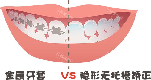 马鞍山鼎植口腔牙齿矫正牙套金属对比隐形牙套