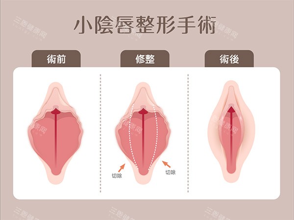 小阴唇整形手术