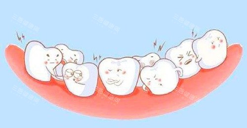 牙齿拥挤动画
