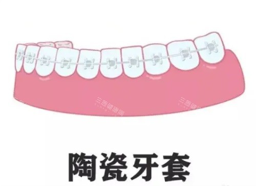 陶瓷牙套示意图