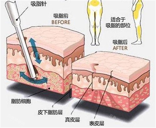 吸脂原理示意图