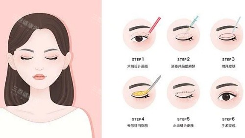 宁波初美星范医疗美容部整形示意图