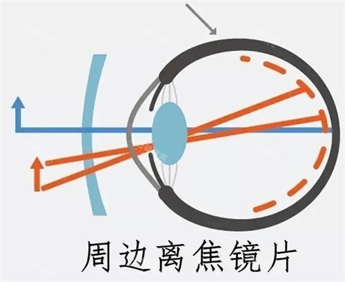 周边离焦镜片