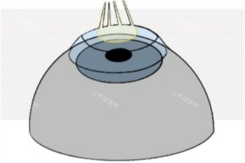 Refractive-Surgery-Techniques-1024x493_副本