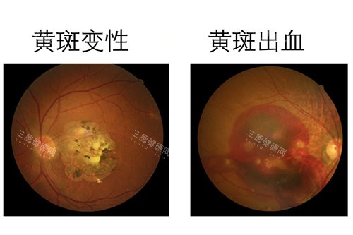 黄斑变性卡通图片展示