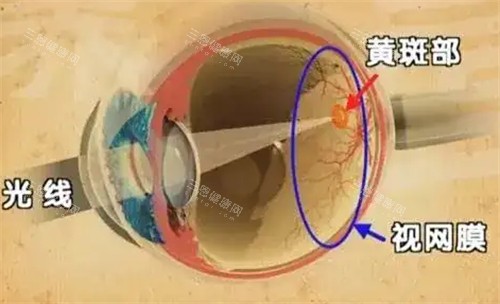 黄斑眼病的发病位置图解
