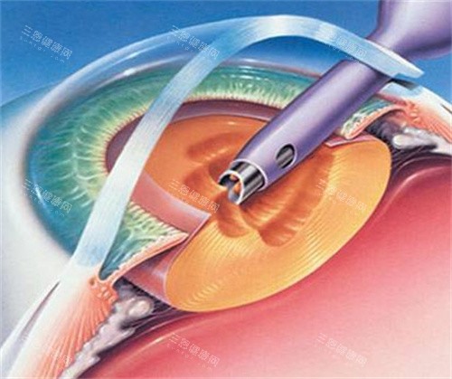 白内障囊外摘除术图片 白内障囊外摘除术图片