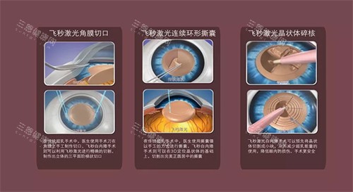 飞秒白内障手术流程 飞秒白内障手术流程