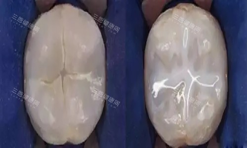 牙齿窝沟封闭卡通示意图