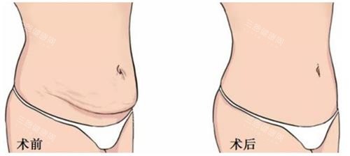 美人鱼腹壁成形手术前后的区别