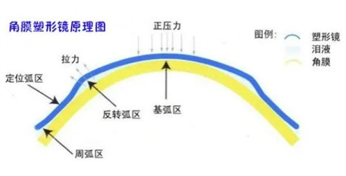 角膜塑形镜原理示意图