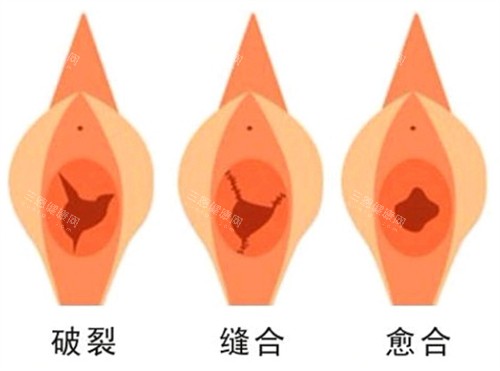 处女膜修复手术前后对比图