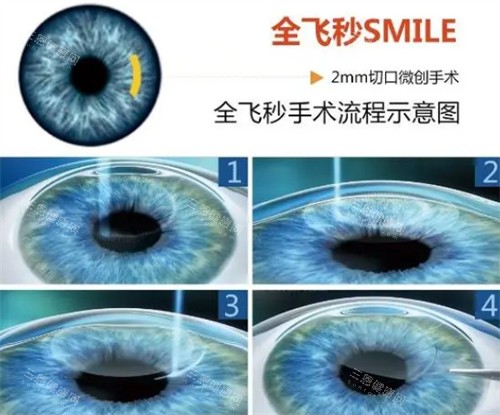 全飞手术流程示意图