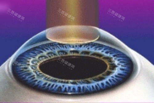 全激光手术