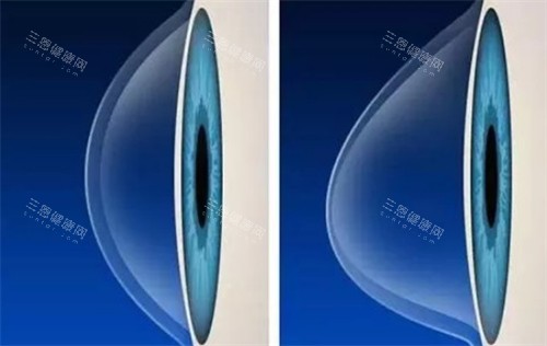 圆锥角膜和正常角膜的不同之处