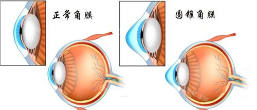 正常角膜和圆锥角膜的不同