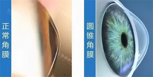 圆锥角膜和正常角膜的区别图解