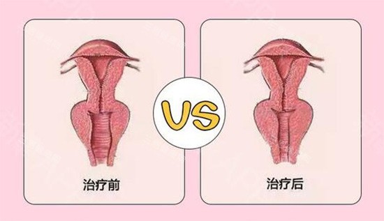 阴道紧缩针前后对比 阴道紧缩针前后对比