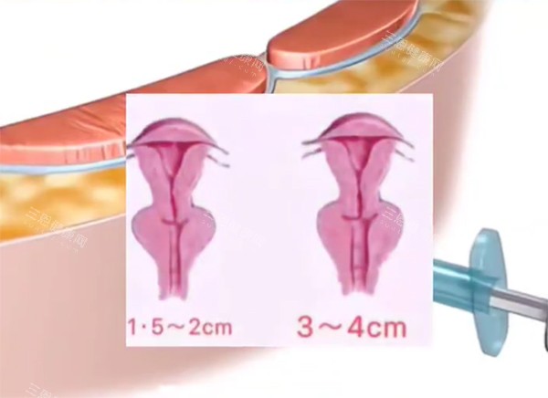 紧缩针对比动画 紧缩针对比动画