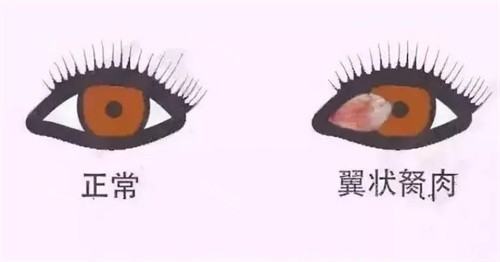 翼状胬肉