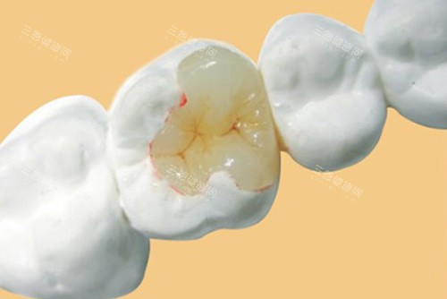 潍坊华贝口腔补牙示意图