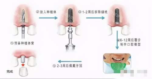 种植牙的6个步骤图解