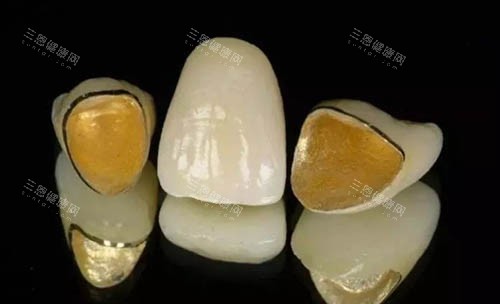 烤瓷牙冠照片