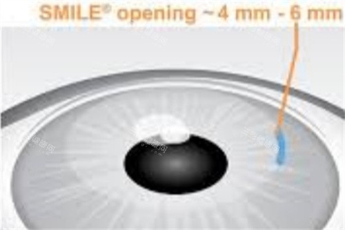 全飞秒创口示意图 全飞秒创口示意图