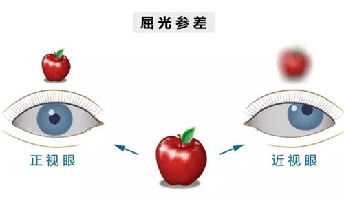 屈光参差 屈光参差