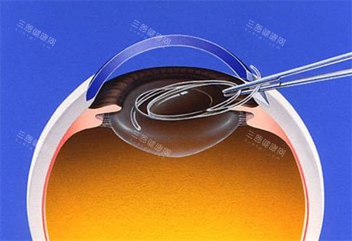 白内障晶体展示图