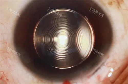 蔡司939人工晶体展示示意图