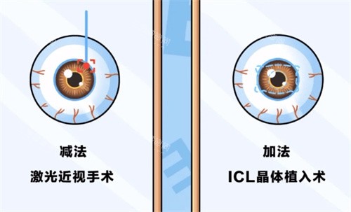 近视手术的分类