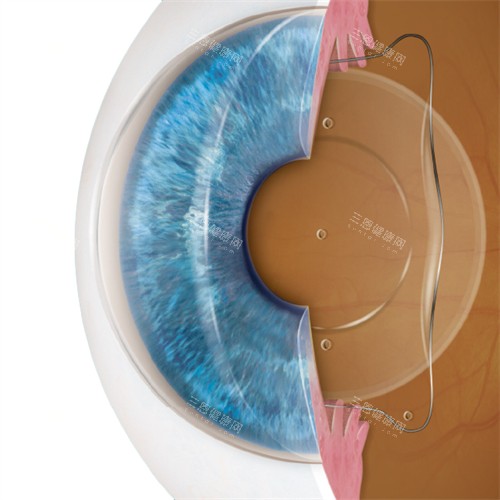 人工晶体植入眼睛示意图