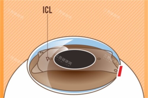 ICL晶体植入后示意图