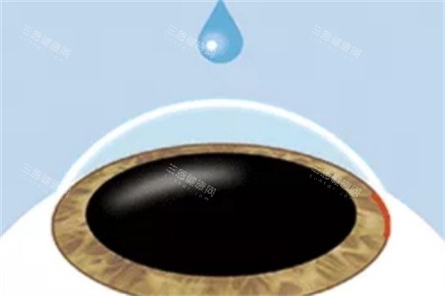 ICL晶体植入麻醉