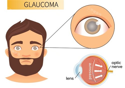 青光眼的表现 青光眼的表现