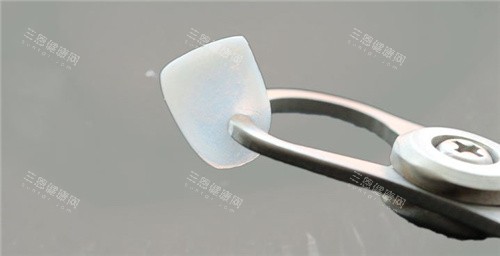 超薄牙齿贴面